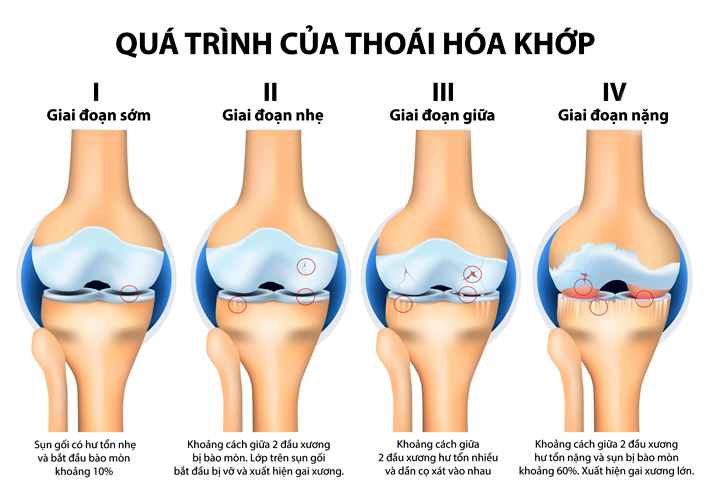 01 Qua Trinh Thoai Hoa Xuong Khop 0