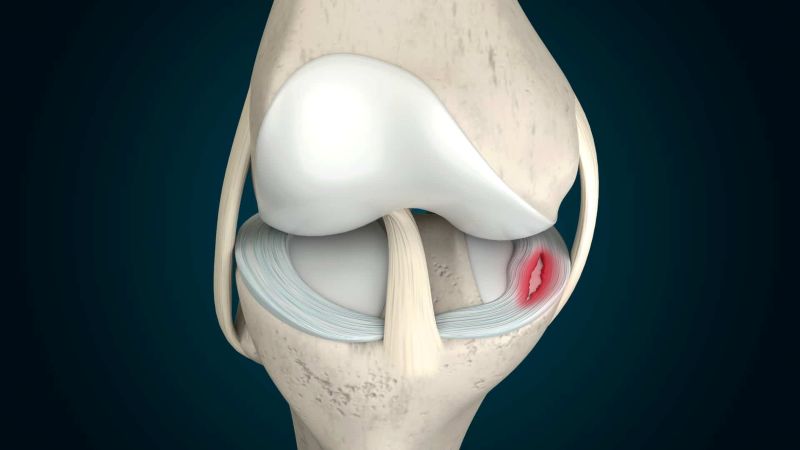 rách sụn chêm tác động đến cấu tạo sụn khớp
