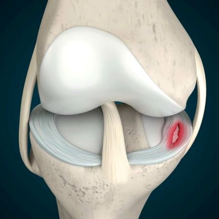 rách sụn chêm có tự lành không