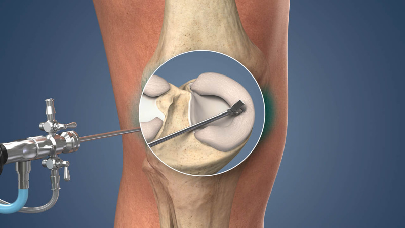điều trị rách sụn chêm