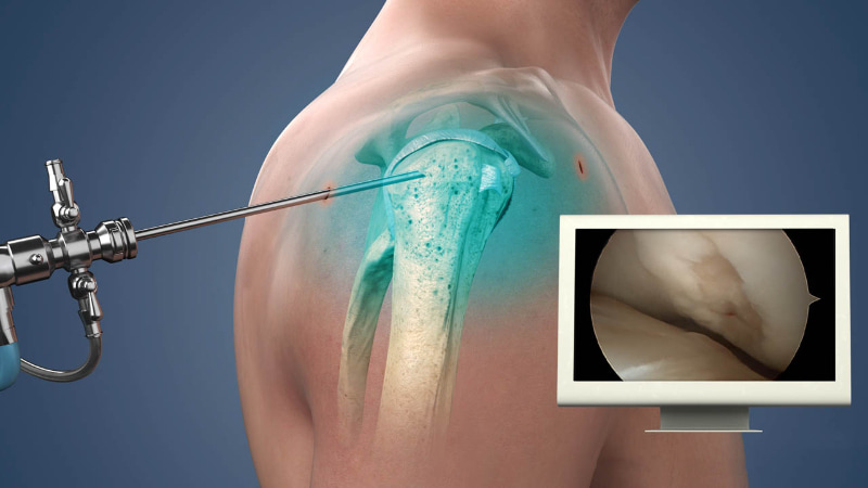 chẩn đoán rách sụn viền khớp vai