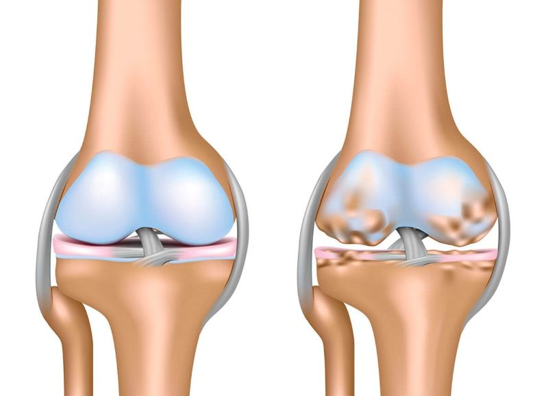 thoái hóa khớp gối do sụn bị bào mòn