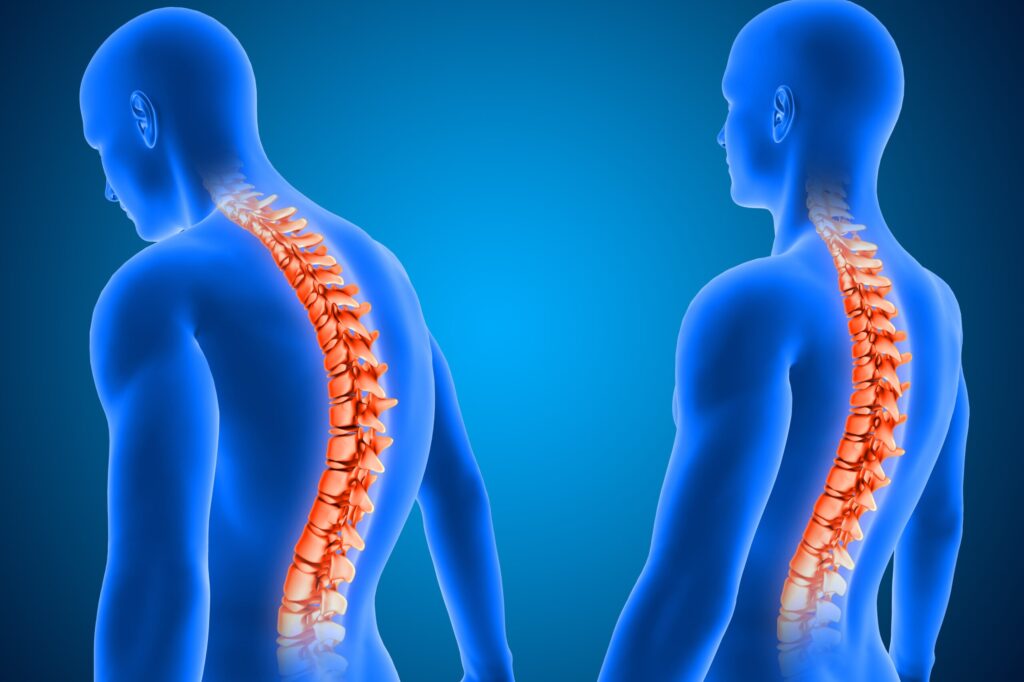 đau nhức xương khớp ở người trẻ là triệu chứng của bệnh viêm cột sống dính khớp