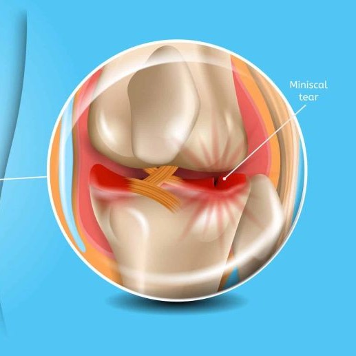 liệu rách sụn chêm trong có nguy hiểm không