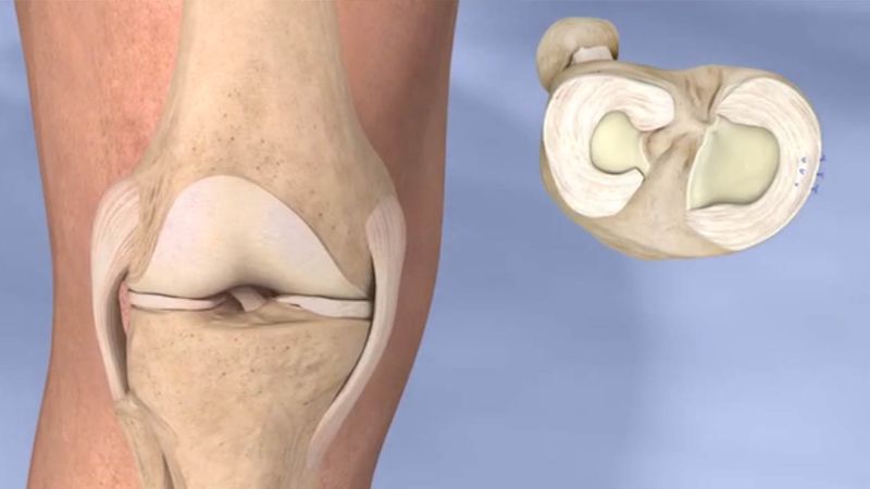 rách sụn chêm trong có nguy hiểm không